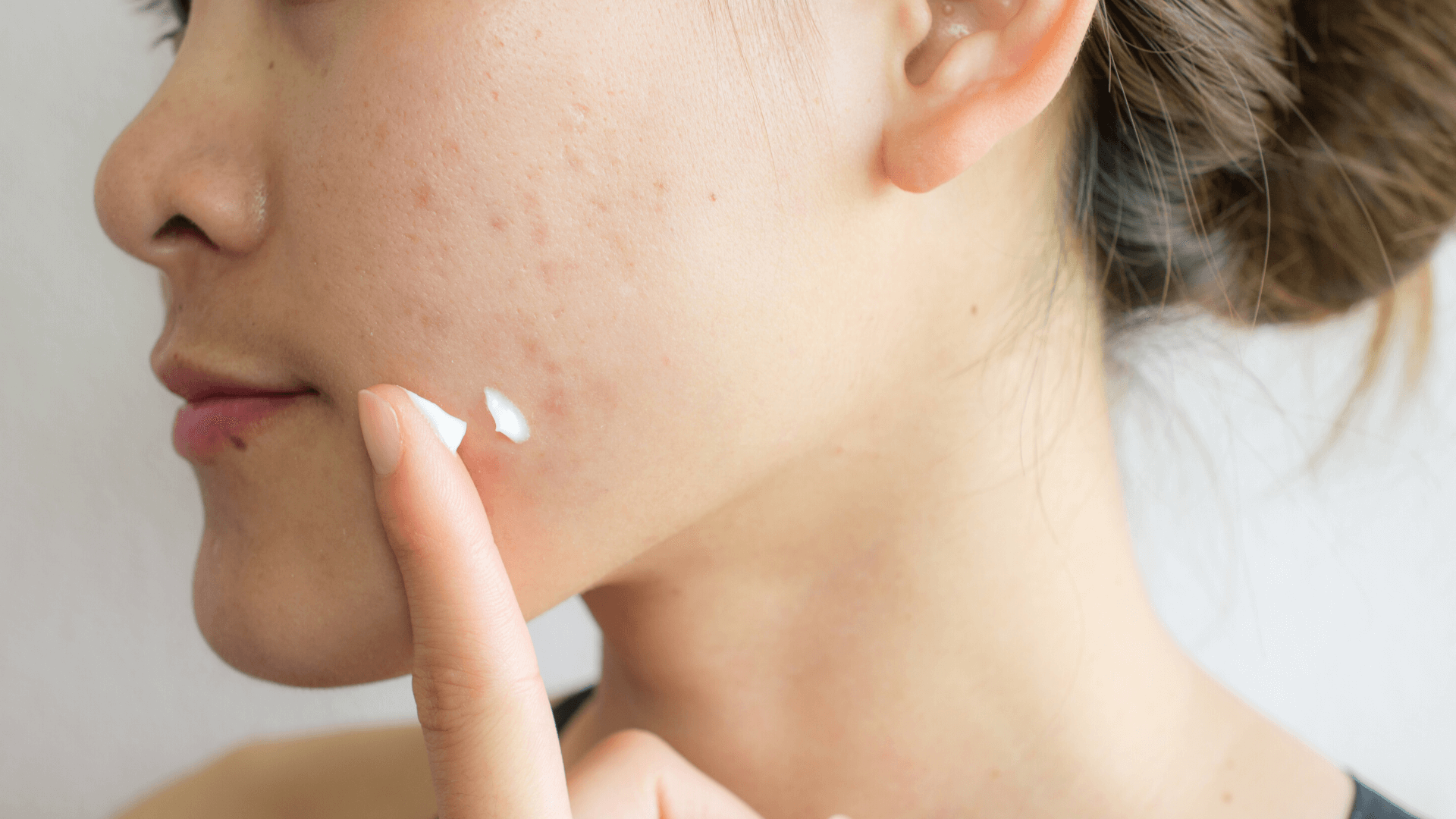 How A Food Intolerance Test Could Clear Up Your Acne Test My Allergy